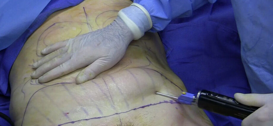 1200px-Fat_removal_using_cannula_during_tumescent_liposuction